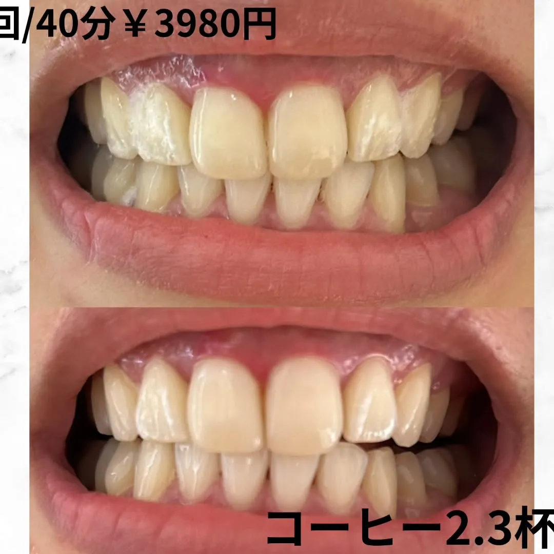 こんにちは🥰ホワイトニングビューティー三川店です✨