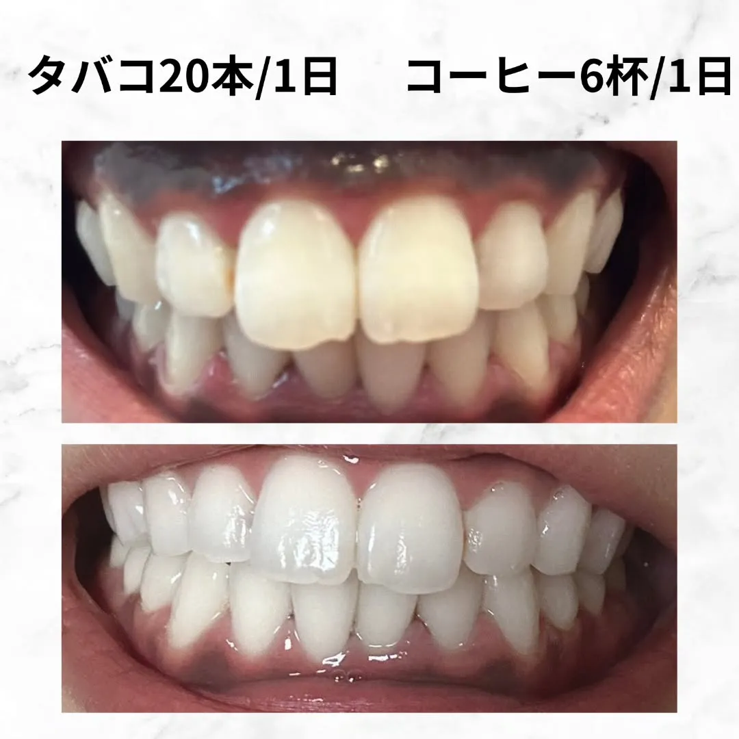 ホワイトニングビューティー三川店です✨