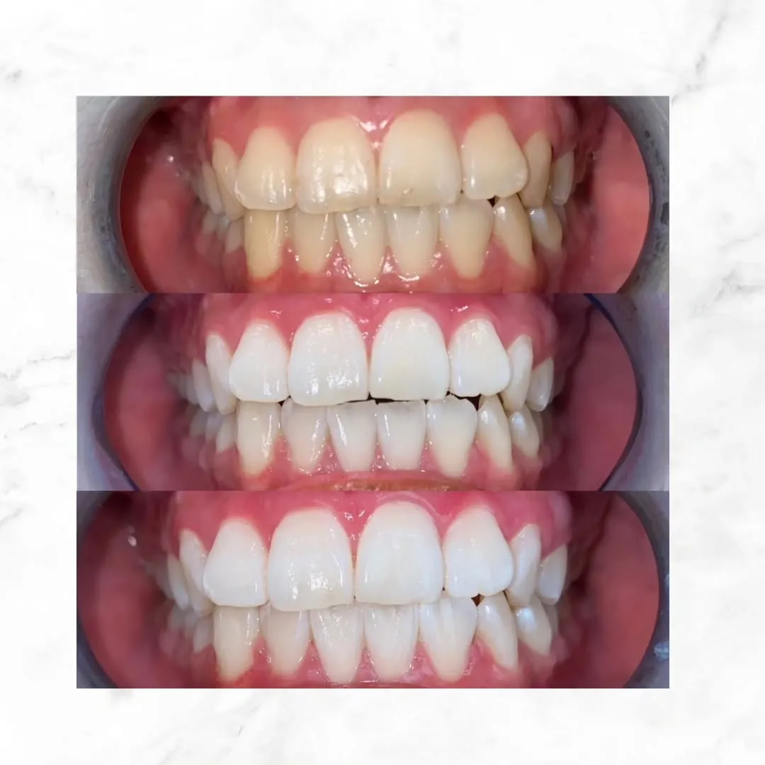 ホワイトニングビューティー三川店です✨