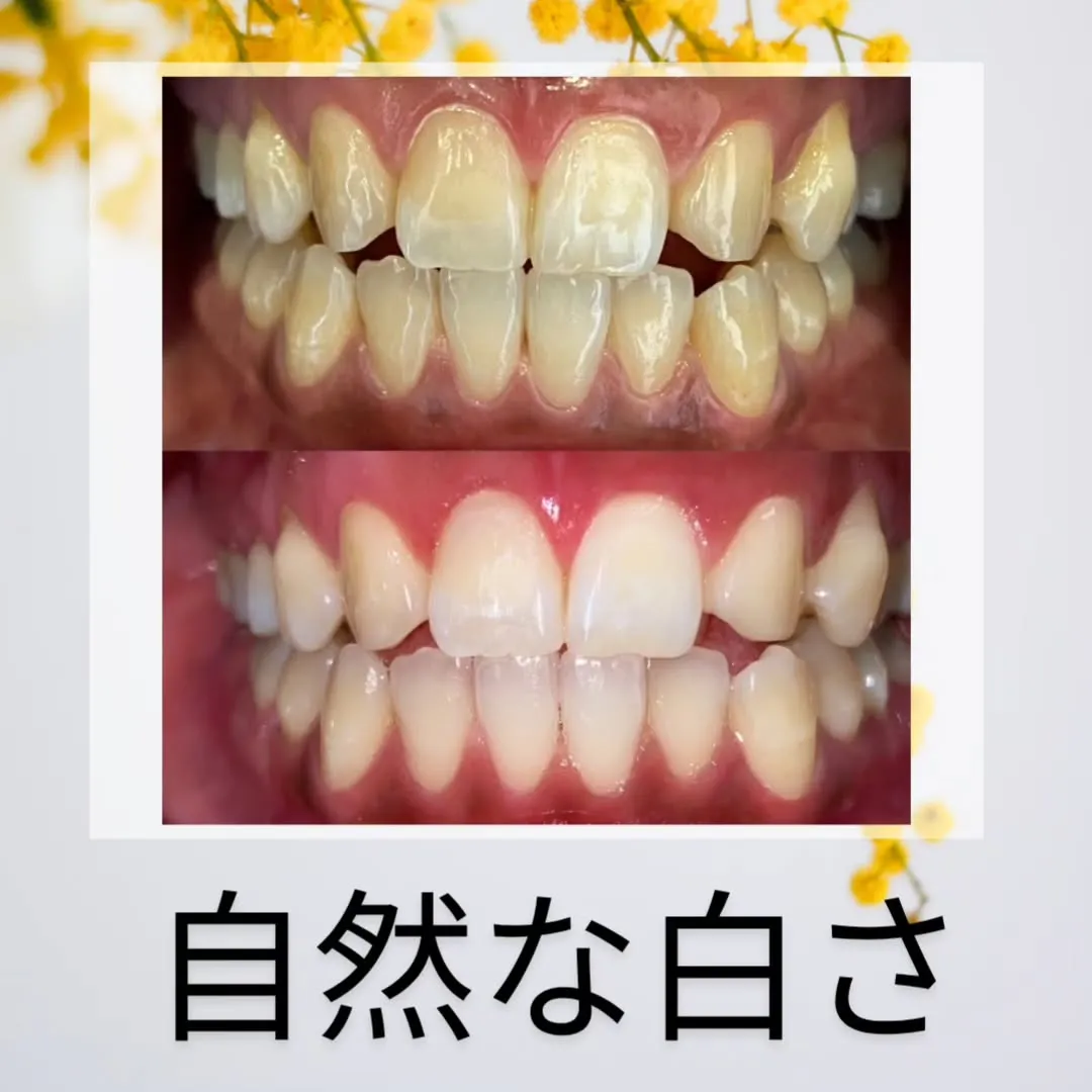 ホワイトニングビューティー三川店です✨