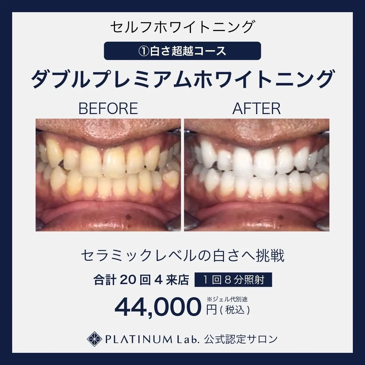 初回限定【ダブルプレミアムホワイトニング】4来店(合計128分)