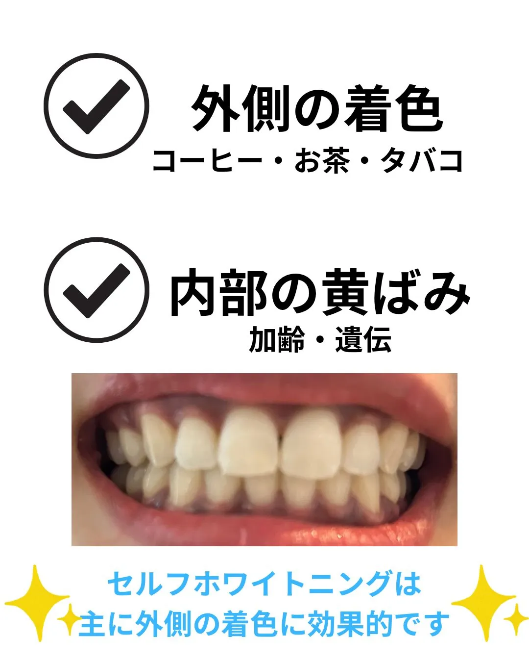 🦷セルフホワイトニングの豆知識🦷