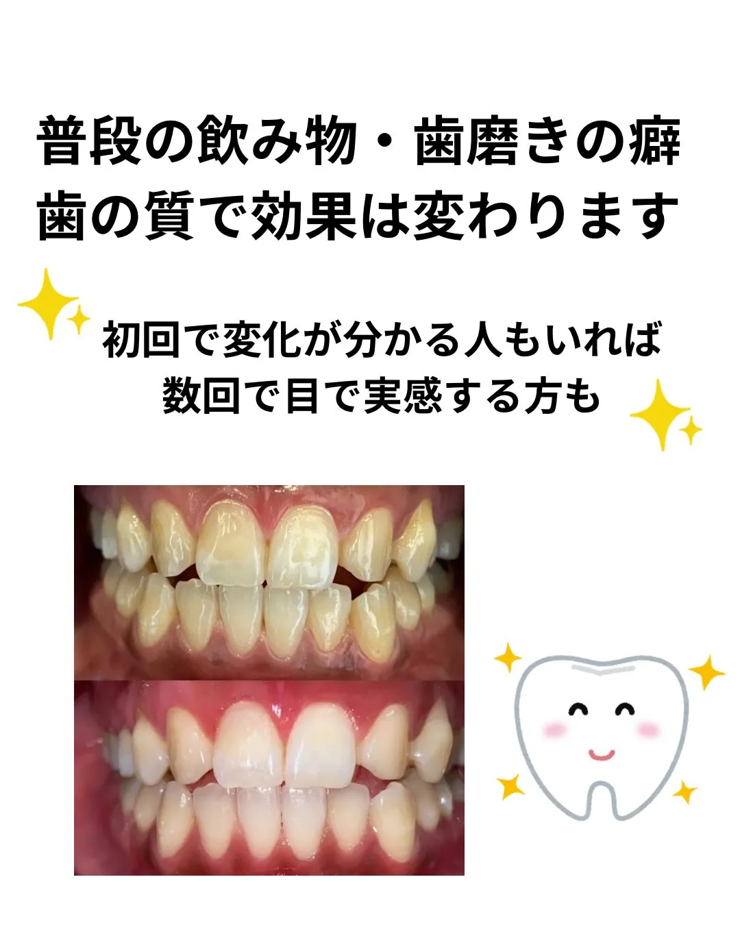 🦷セルフホワイトニングの豆知識🦷