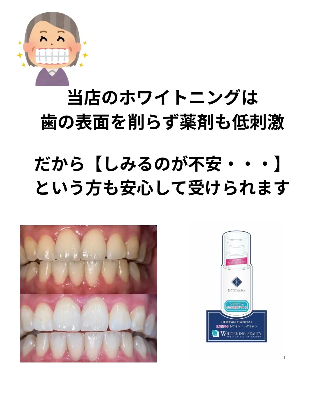 🦷セルフホワイトニングの豆知識🦷