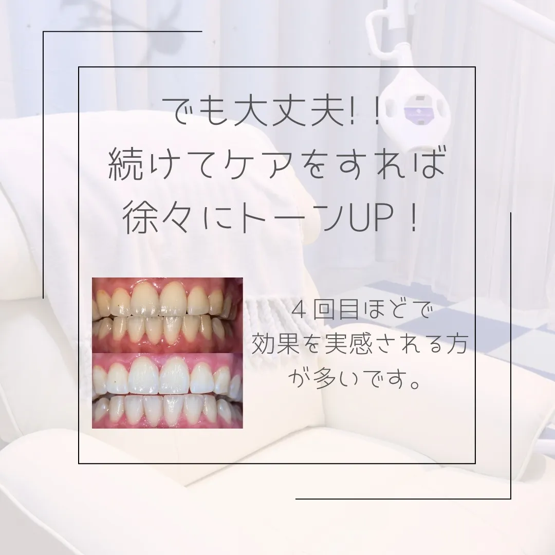 犬歯の黄ばみ気になりませんか？